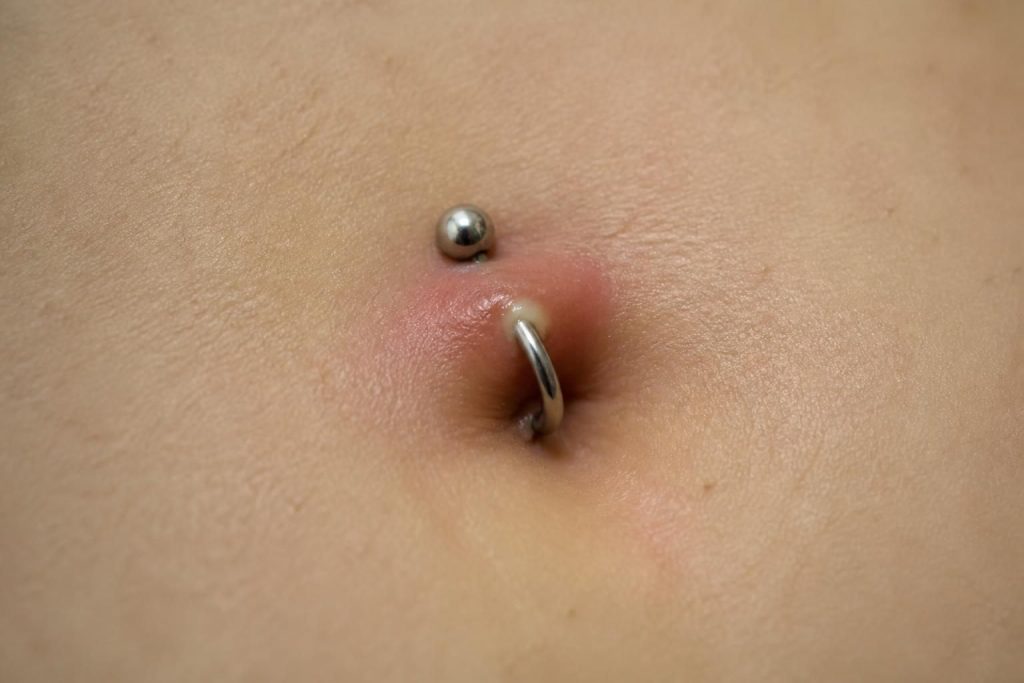 découvrez les causes d'un nombril infecté, les traitements adaptés et les précautions à prendre selon l’âge et la présence d’un piercing pour prévenir toute complication.